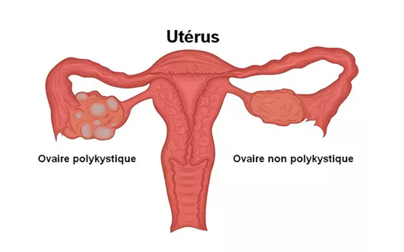 Syndrome des ovaires polykystiques (SOPK) - Soignants, témoignages